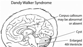 Dandy Walker syndrome