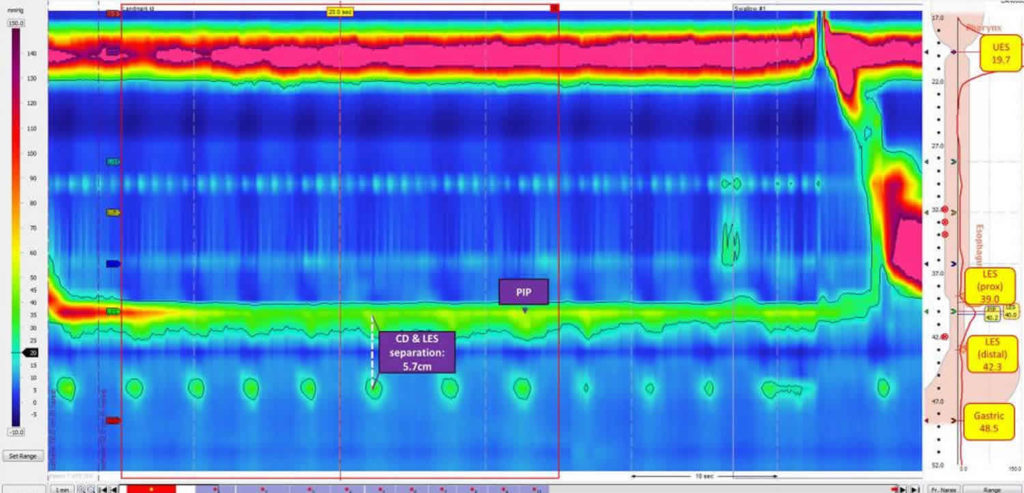 esophageal-manometry-study-prep-procedure-results-risks