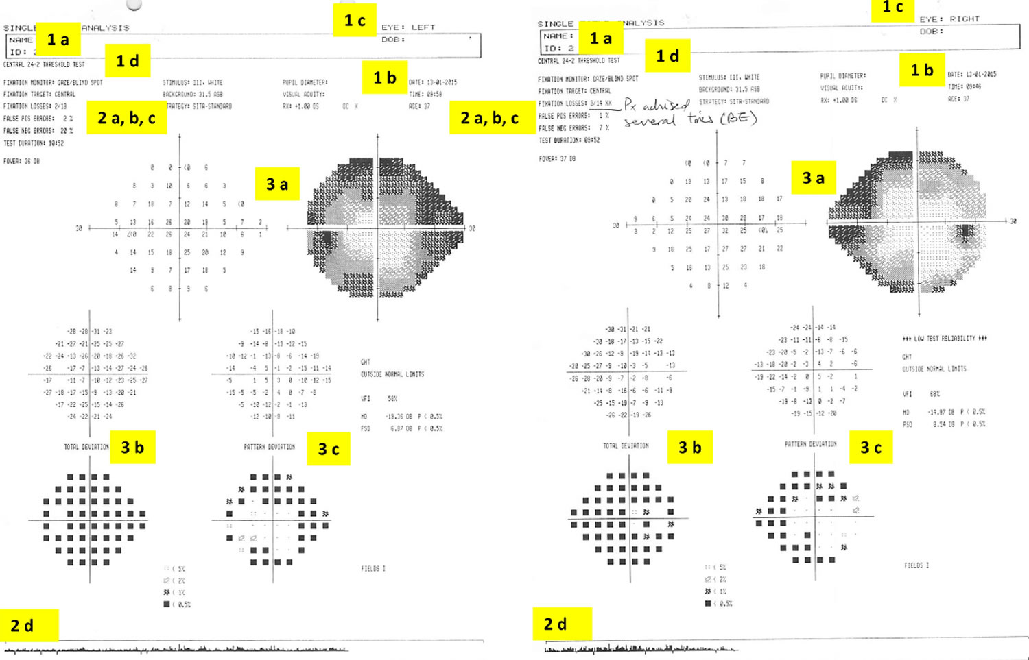 Vivid Can You Cheat A Visual Field Test Image Illustration Vivid Can You Cheat A Visual Field Test Image Illustration