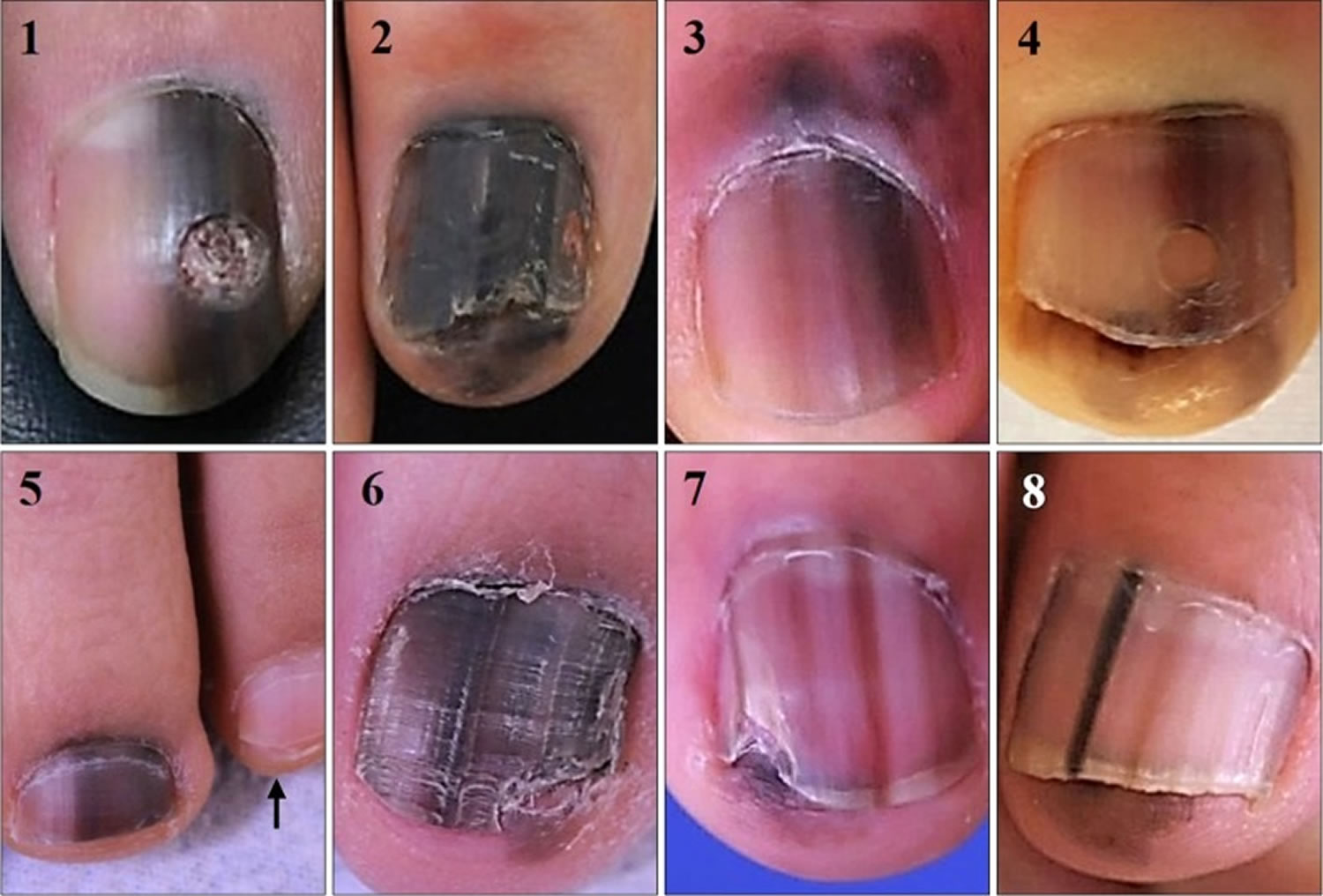 Share 126+ acral lentiginous melanoma nail symptoms - songngunhatanh.edu.vn