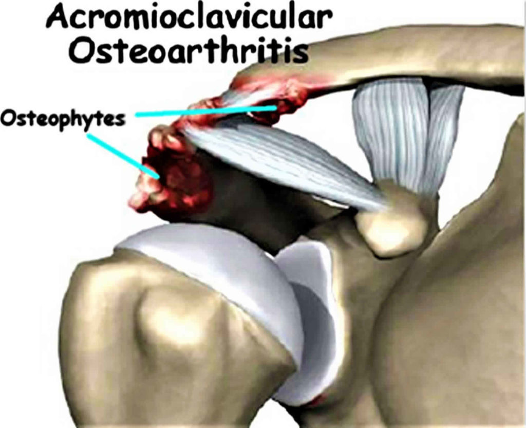 Acromioclavicular Joint Acromioclavicular Joint Injury Separation Osteoarthritis