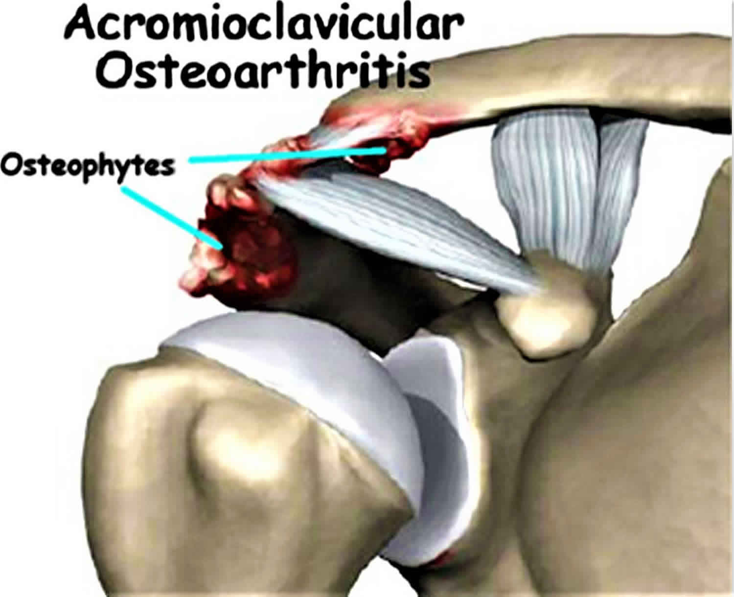 K Shoulder Injury Osteoarthritis Of The Acromioclavicular Joint My