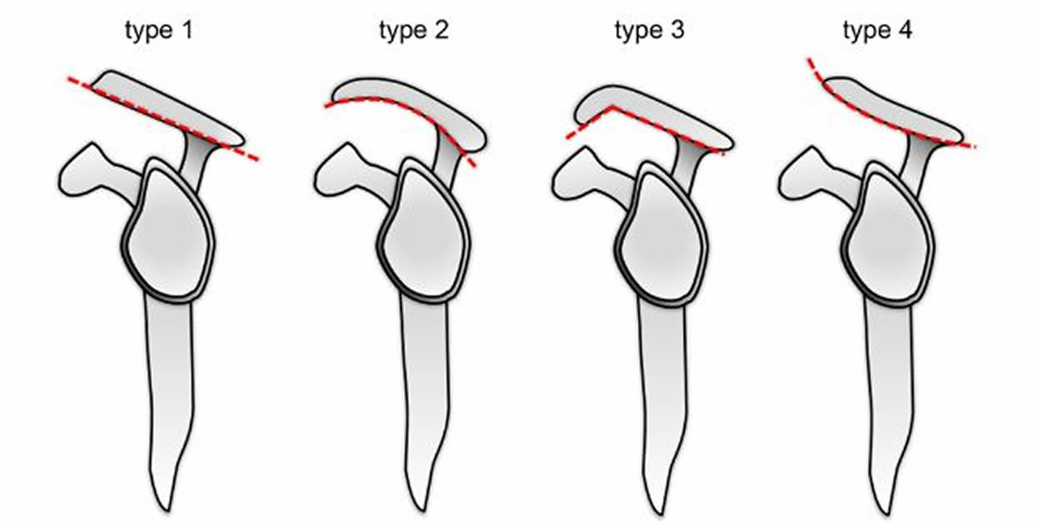 Acromion Of Scapula Acromion Types And Acromion Fracture