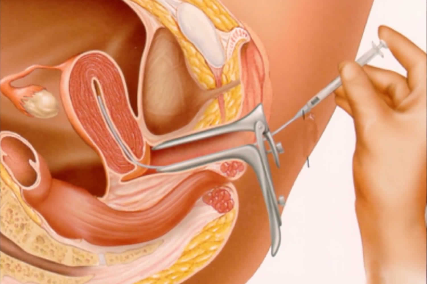 Artificial Insemination Types Artificial Insemination Process Risks