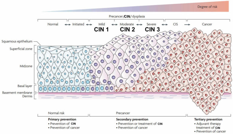 Carcinoma in situ definition, breast, skin, cervix & bladder