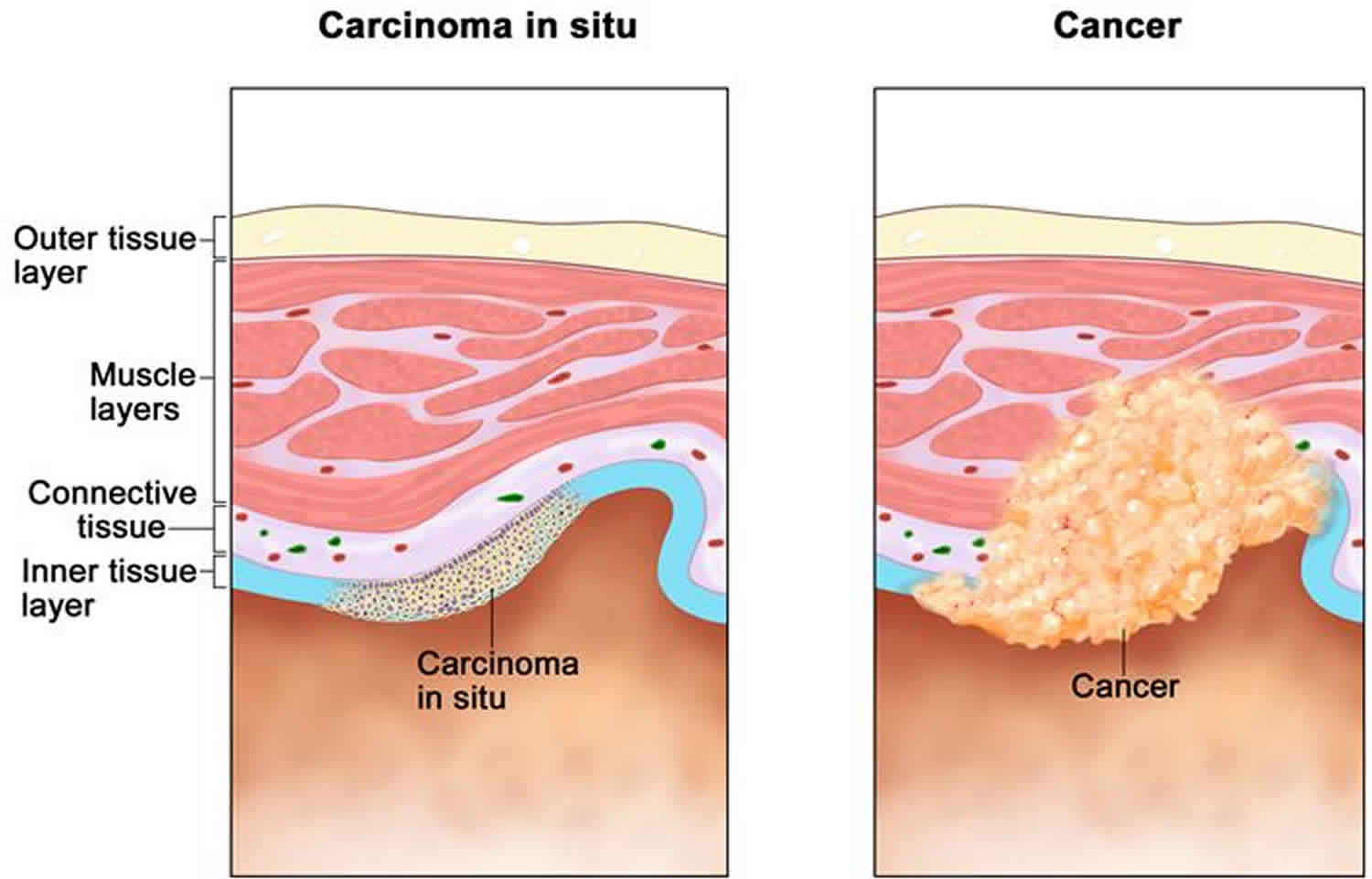 Carcinoma In Situ Definition Breast Skin Cervix Bladder