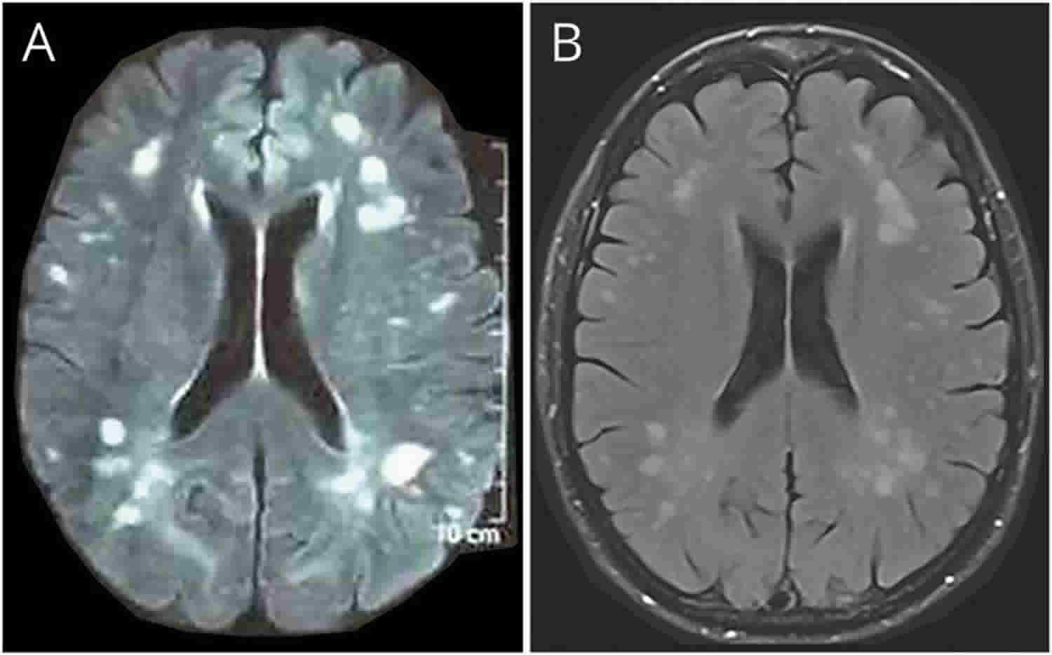 Cerebral edema or brain swelling causes, symptoms, diagnosis & treatment