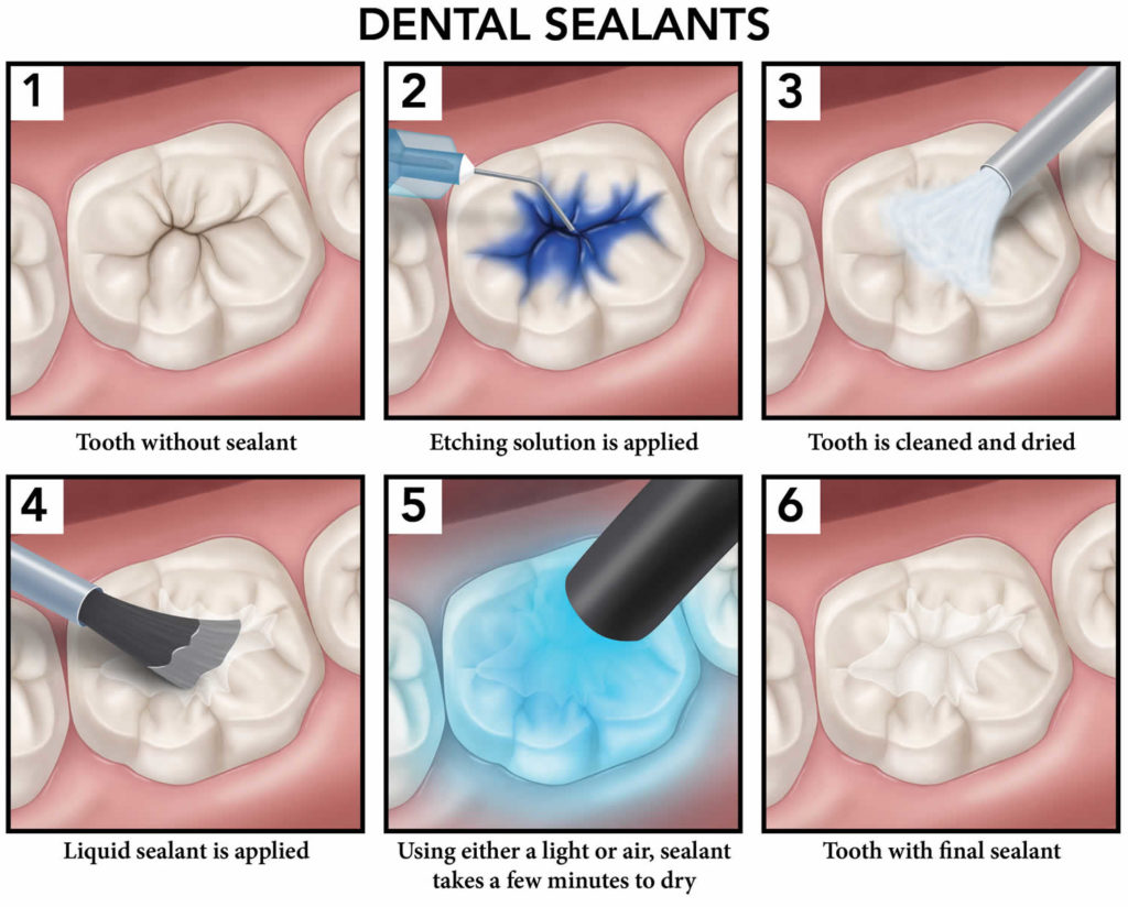 Dental sealants purpose, procedure, safety & controversy