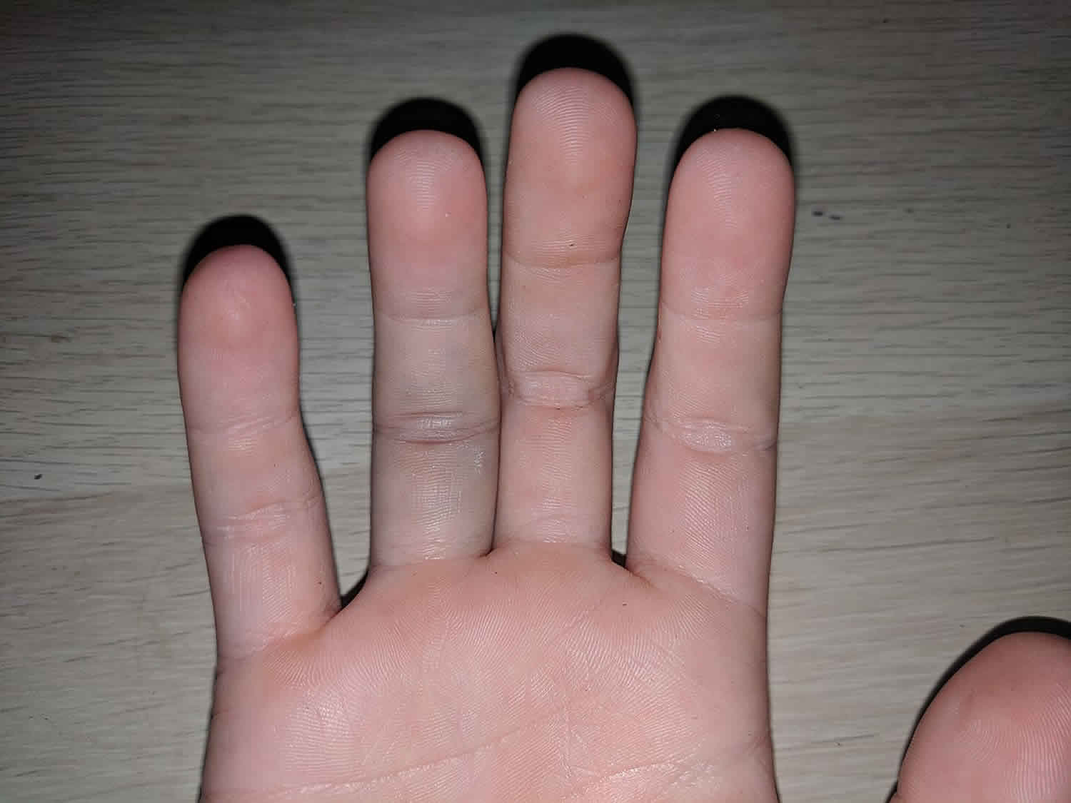 mallet-finger-definitions-symptoms-and-treatment-treat-finger-injury