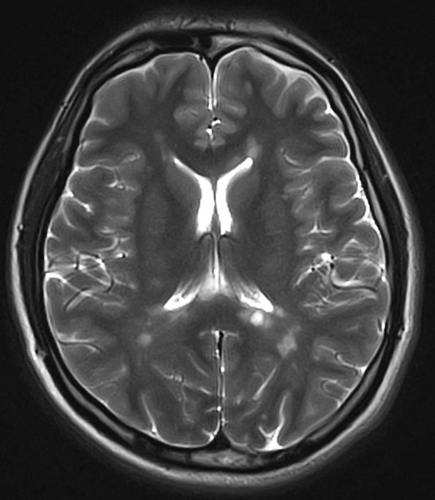 Demyelination Definition Causes Symptoms Diagnosis Treatment   Multiple Sclerosis Demyelination MRI 890x1024 