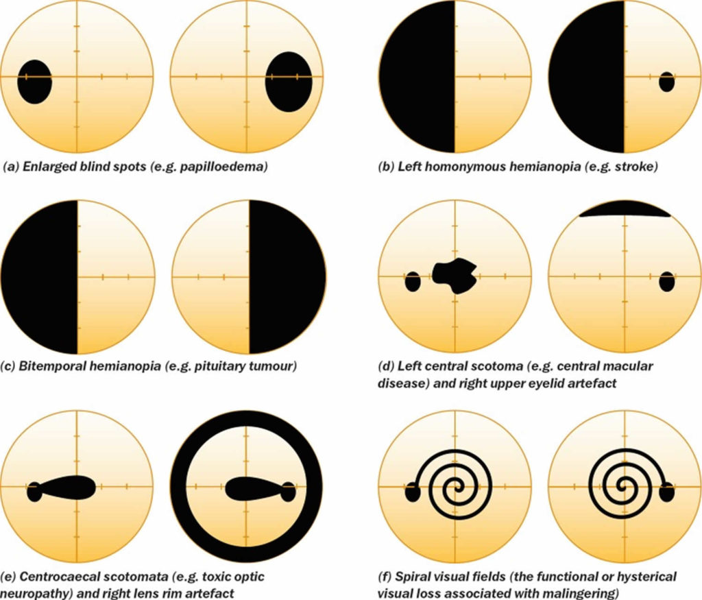 Field Of Vision Test