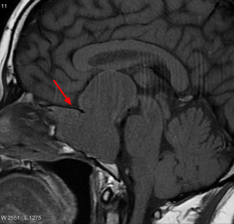 Pituitary Adenoma Causes Symptoms Diagnosis Treatment And Prognosis 2141