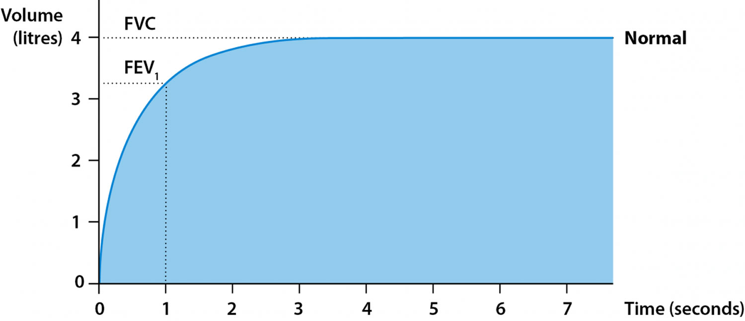 Spirometry test, spirometry results & spirometry interpretation