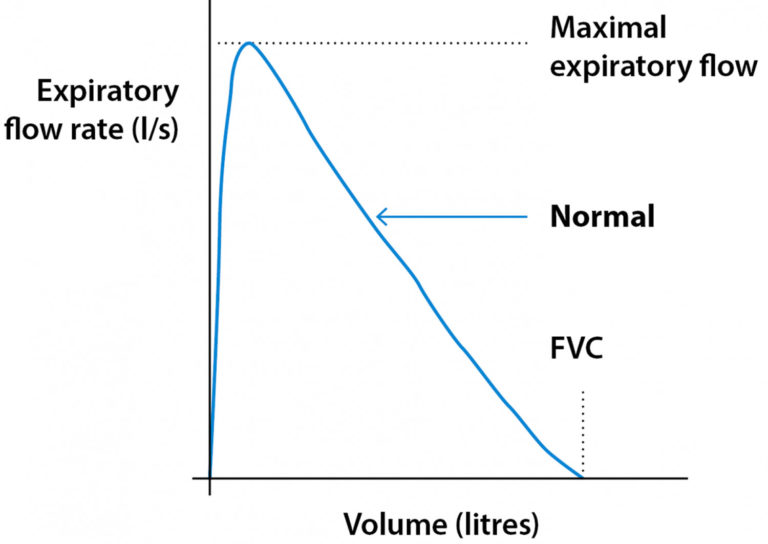 Spirometry test, spirometry results & spirometry interpretation