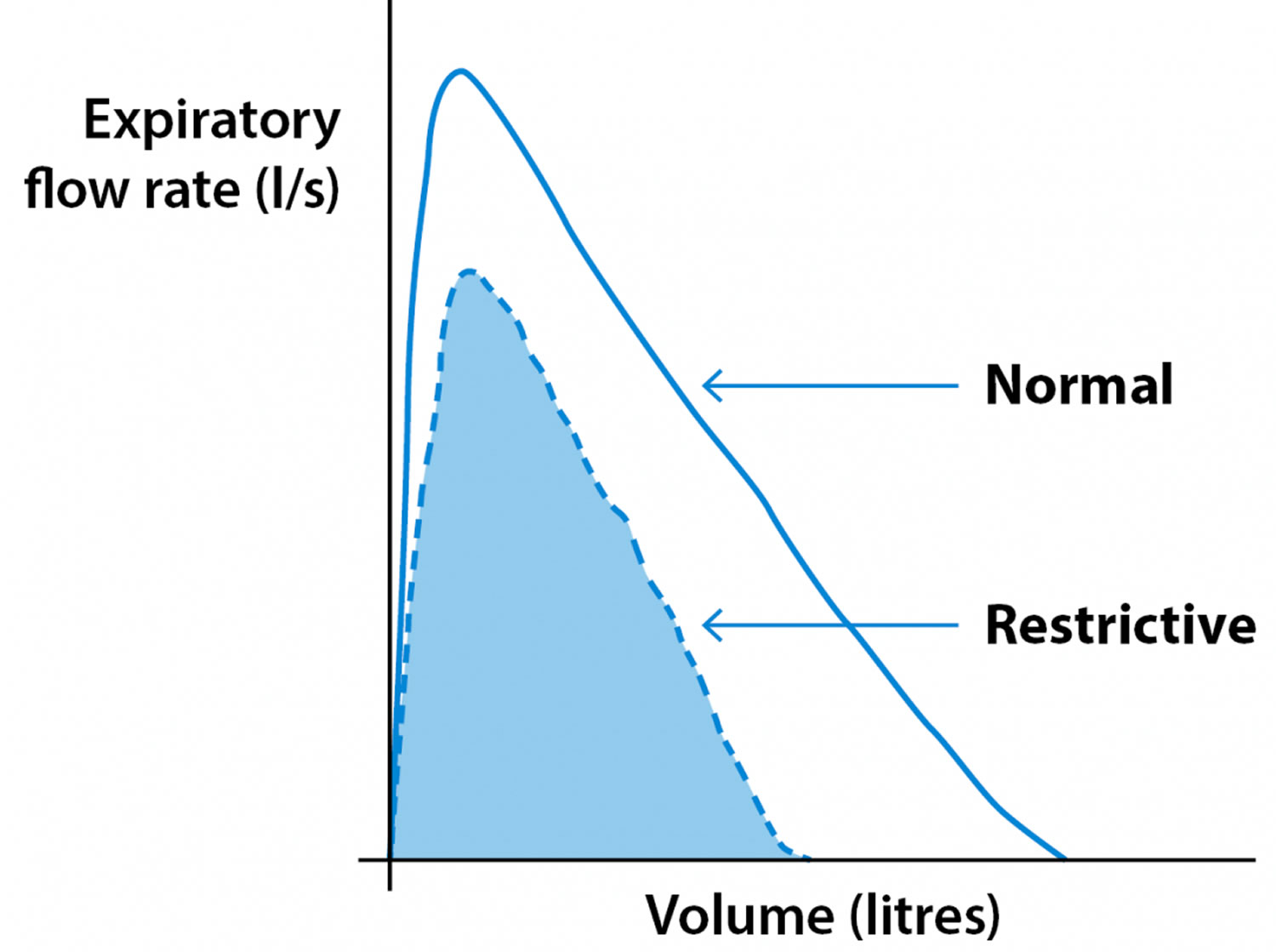 Restrictive lung disease definition, causes, symptoms, diagnosis