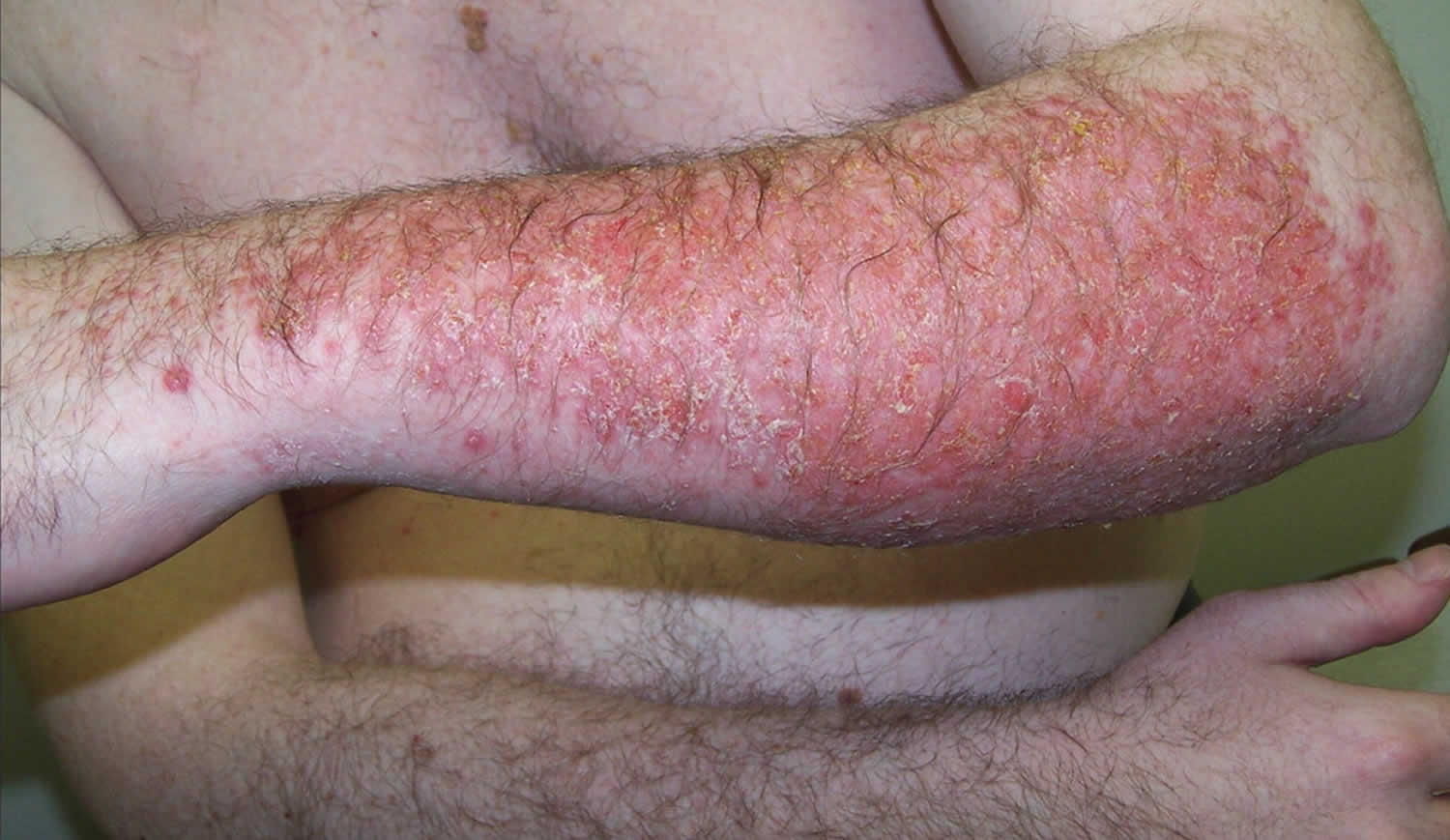 allergic-contact-dermatitis-causes-symptoms-diagnosis-treatment