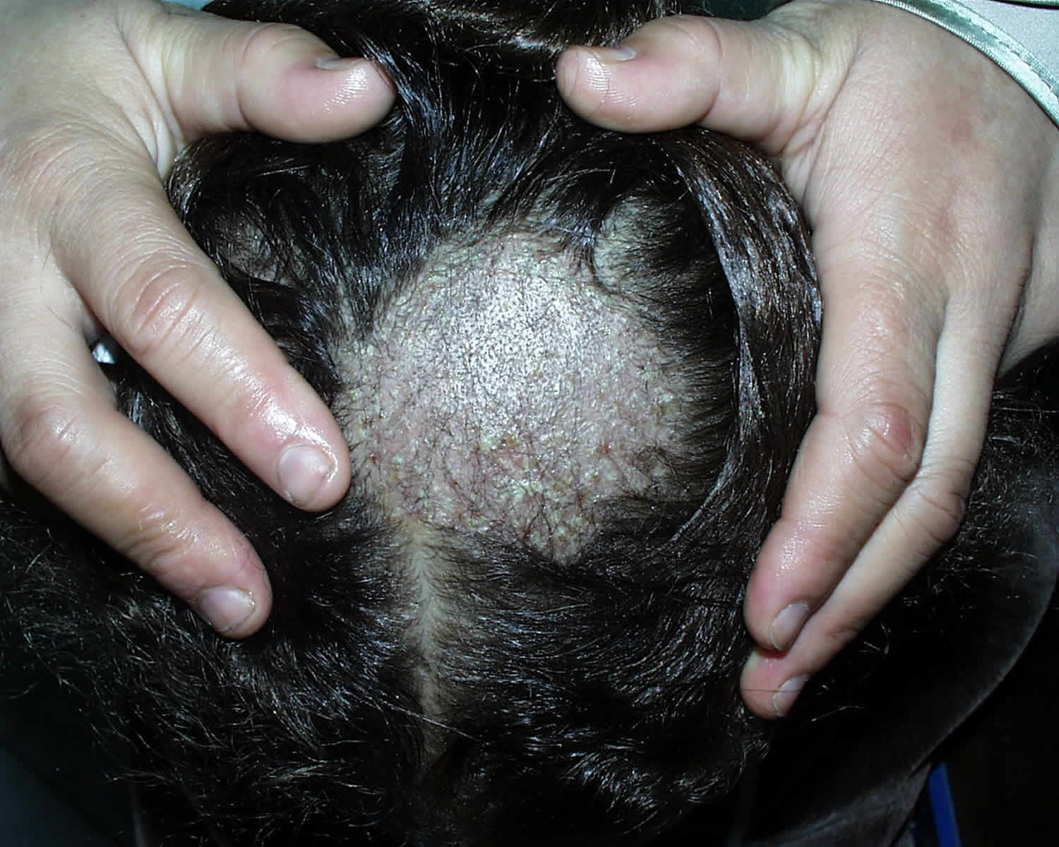 pictures tinea capitis scalp