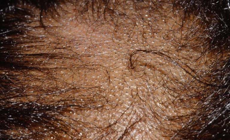 Tinea Capitis Scalp, Causes, Symptoms, Diagnosis & Tinea Capitis Treatment