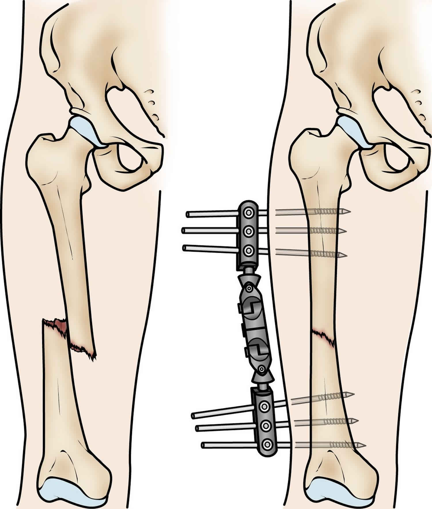 stress fracture in lower back