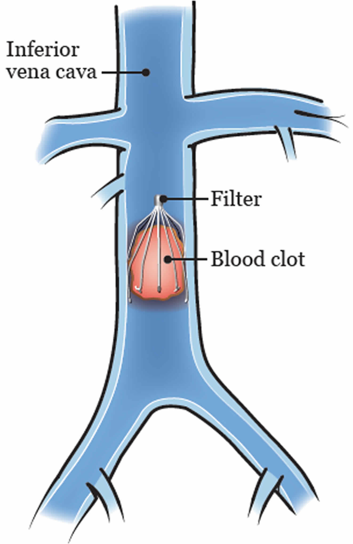 Inferior vena cava anatomy, function, filter & inferior