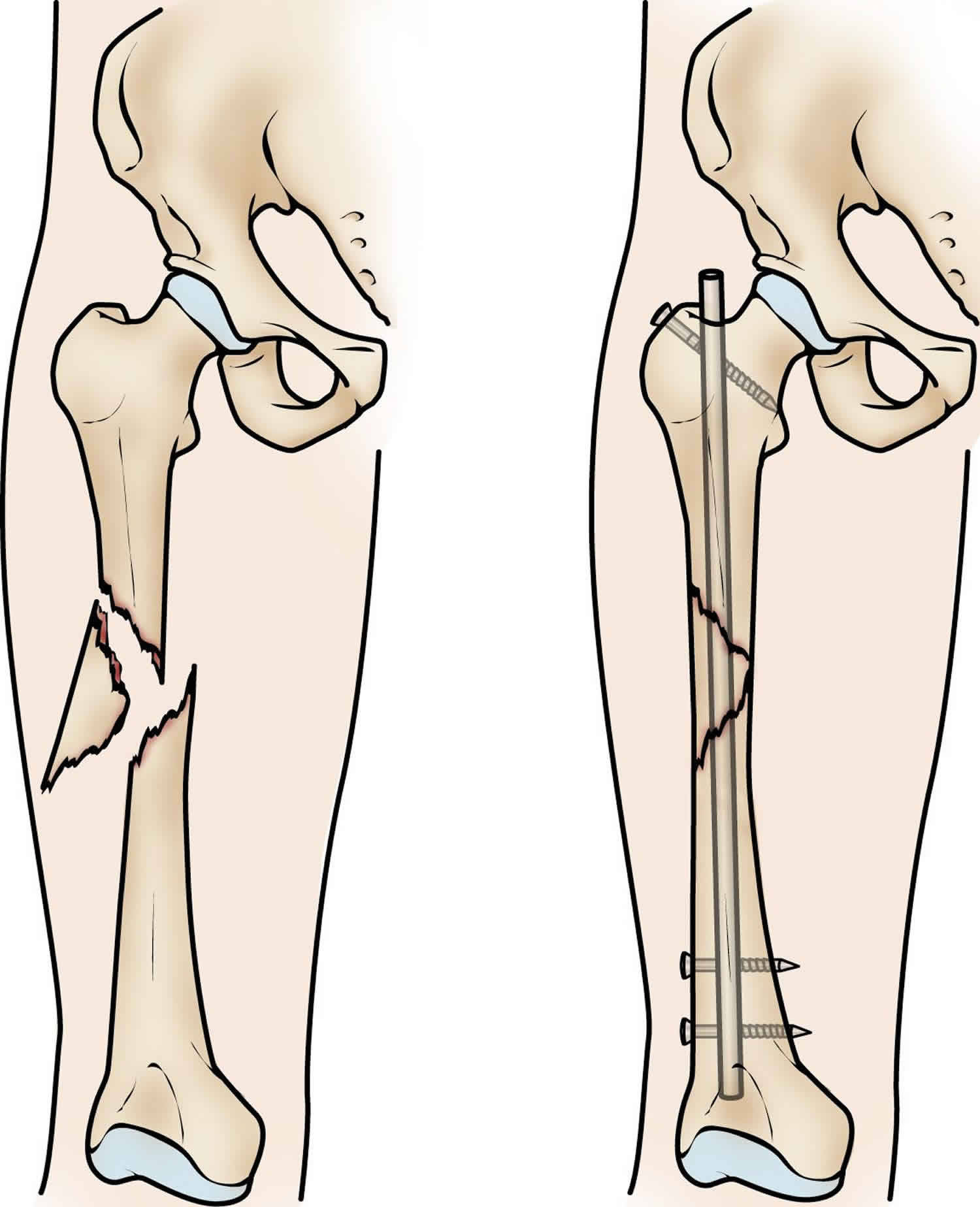 Почему болит кость после перелома