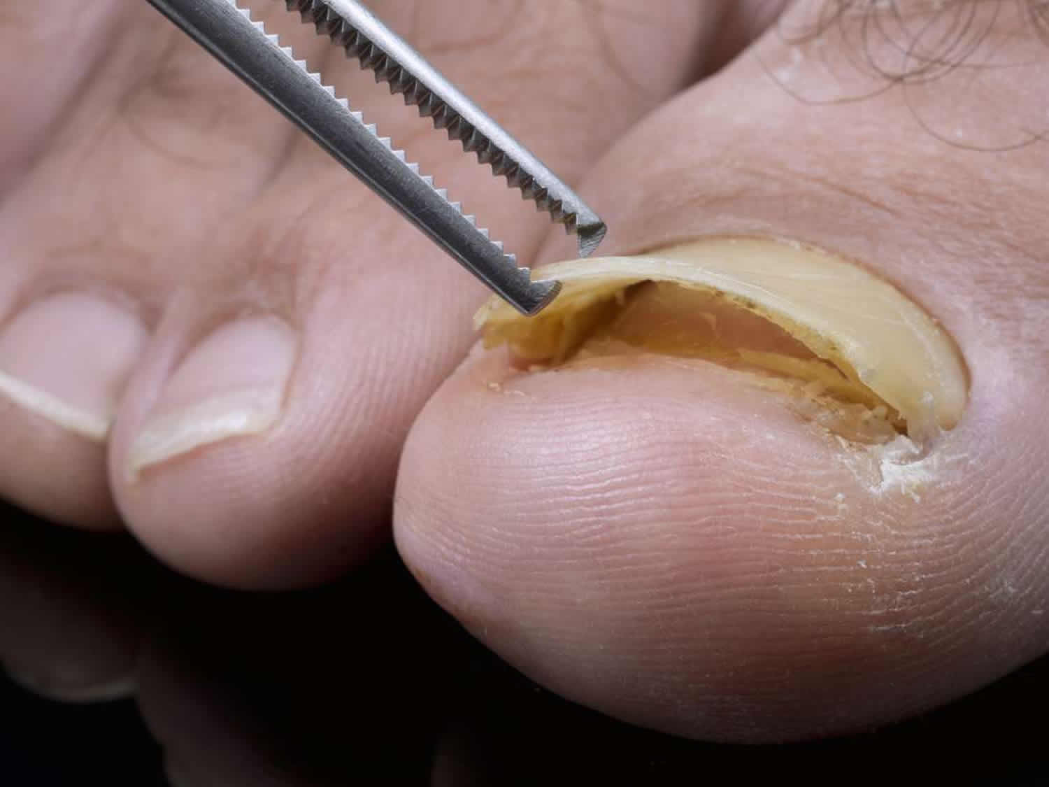 How to Care for a Big Toe Nail That is Changing Color and Falling Off - wide 2