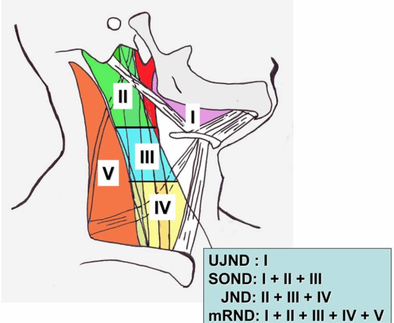 Neck dissection surgery, types, indications, risks & complications