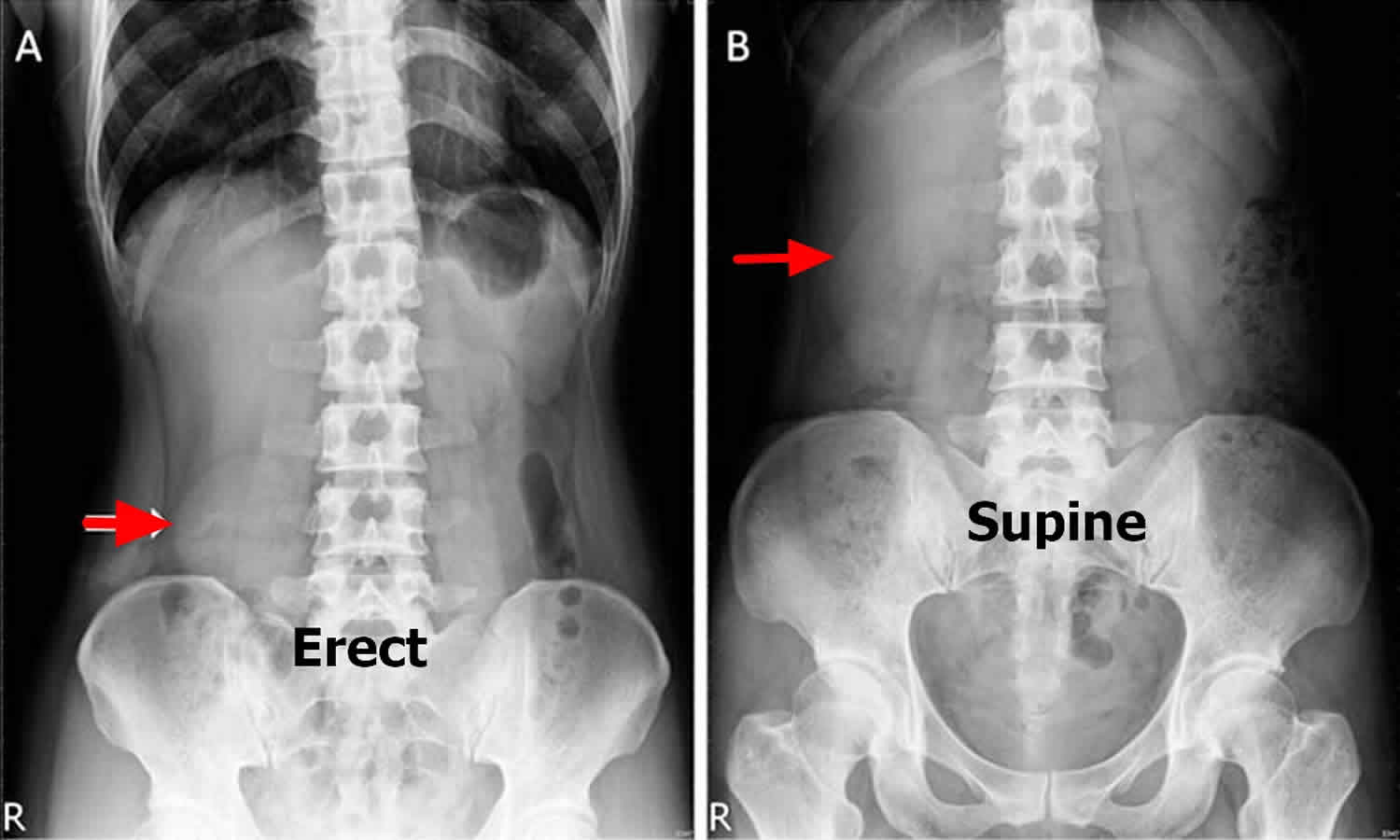 5 x ray. Нефроптоз опущение почки. Нефроптоз 1 степени. Нефроптоз рентген степени. Нефроптоз слева на УЗИ.