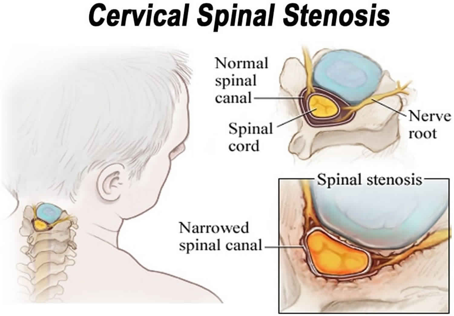 Can Spinal Stenosis Affect The Bladder