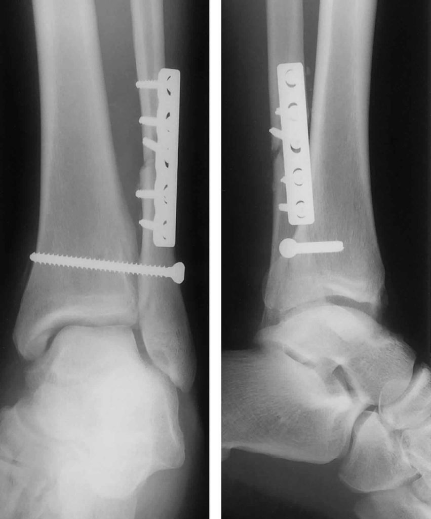 Transverse Fracture Transverse Process Fracture Causes Treatment