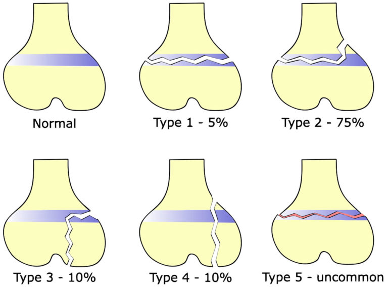 Salter Harris fracture definition, types, symptoms, diagnosis & treatment