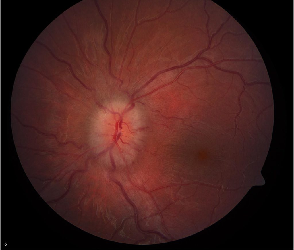 Papilledema causes, symptoms, grades, stages & papilledema treatment