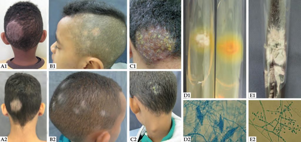 Tinea Capitis Scalp Causes Symptoms Diagnosis And Tinea Capitis Treatment 0269