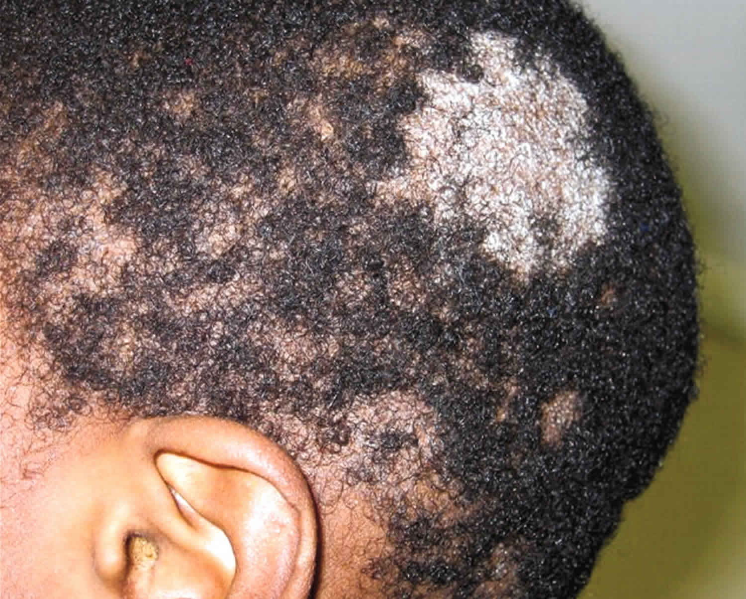 Tinea capitis scalp, causes, symptoms, diagnosis & tinea capitis treatment