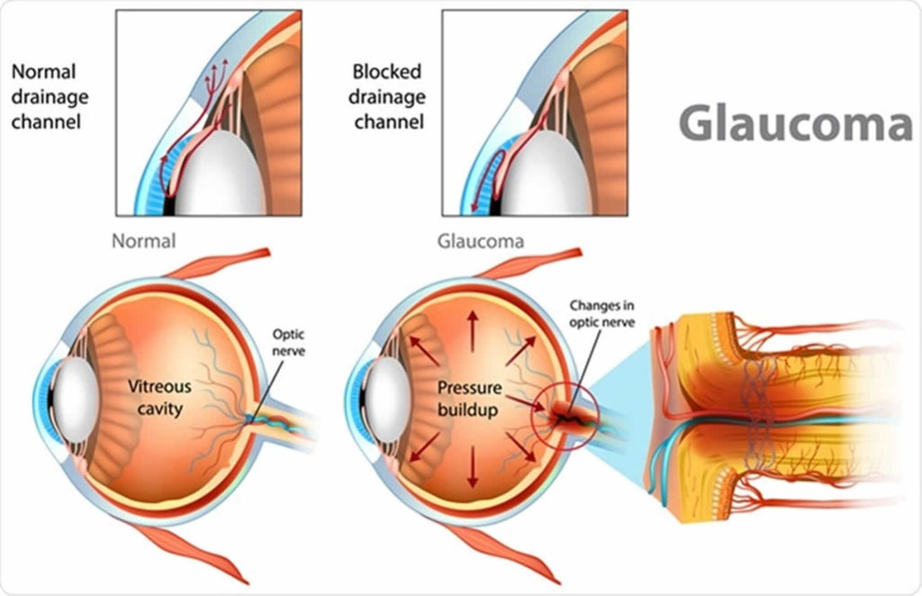 peripheral-vision-causes-of-peripheral-vision-problems-treatment