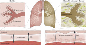 Pulmonary fibrosis causes, types, symptoms, diagnosis, stages & treatment