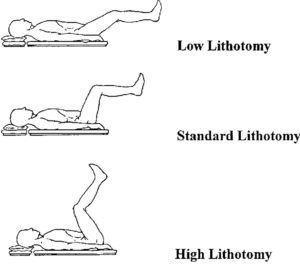 Lithotomy position uses, types, lithotomy position complications