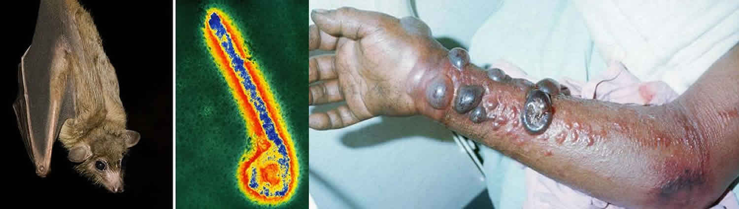 Marburg virus transmission, disease, symptoms, diagnosis ...