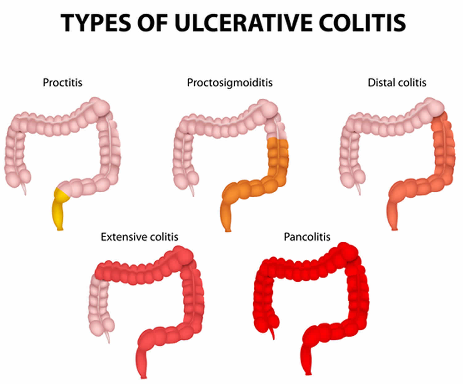 Pancolitis Causes Symptoms Complications Diagnosis Treatment