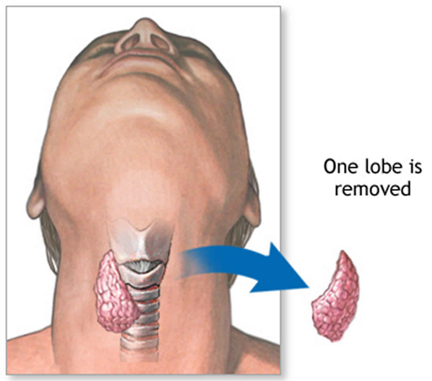 solitary-thyroid-nodule-causes-symptoms-diagnosis-treatment-prognosis