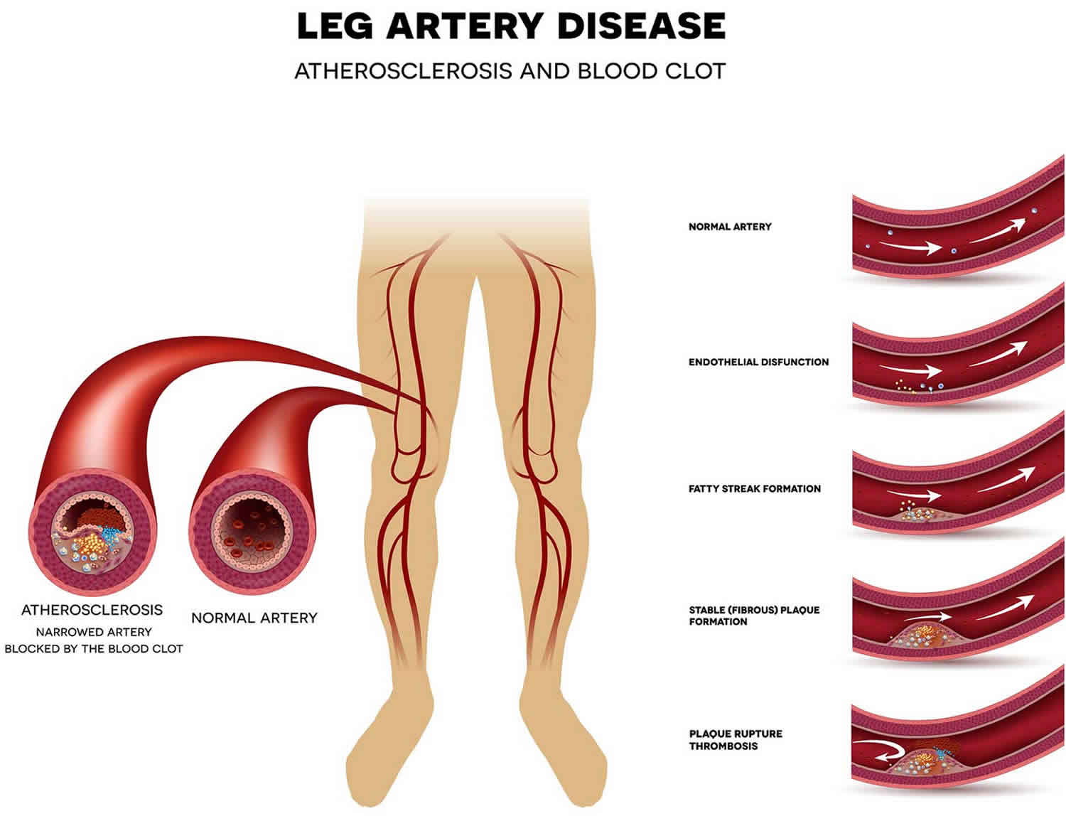 Peripheral Vascular Disease Causes Signs Symptoms Diagnosis Treatment