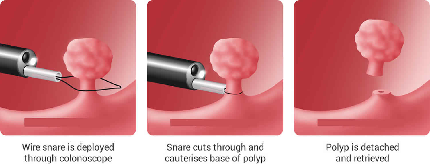Hysteroscopy Polypectomy
