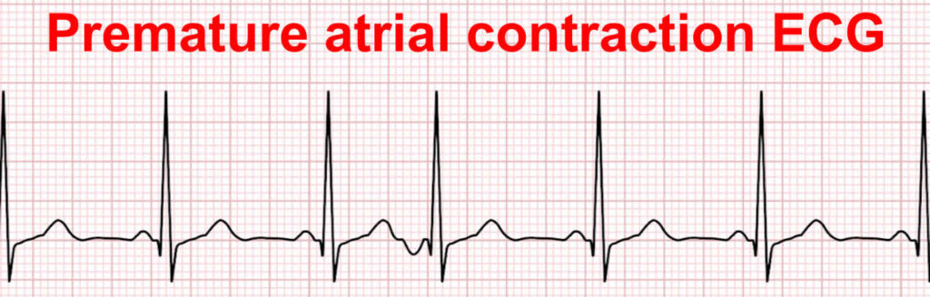 Premature atrial contraction definition, causes, symptoms, diagnosis ...