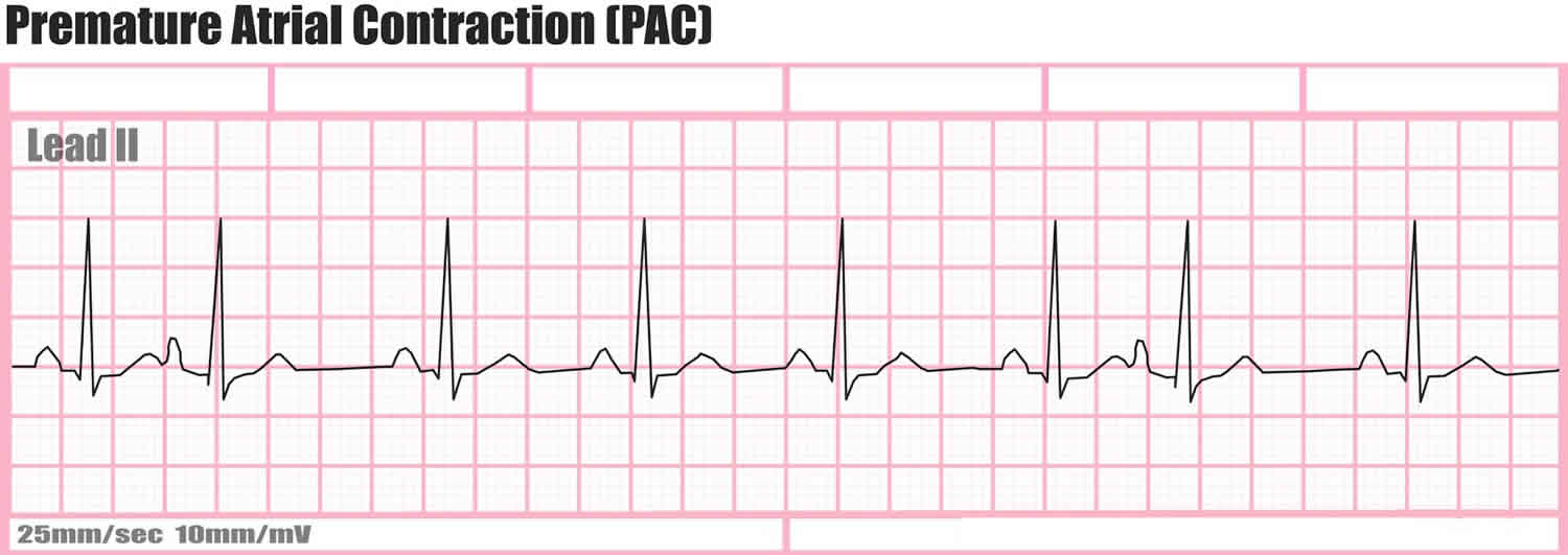 Premature atrial contraction definition, causes, symptoms, diagnosis