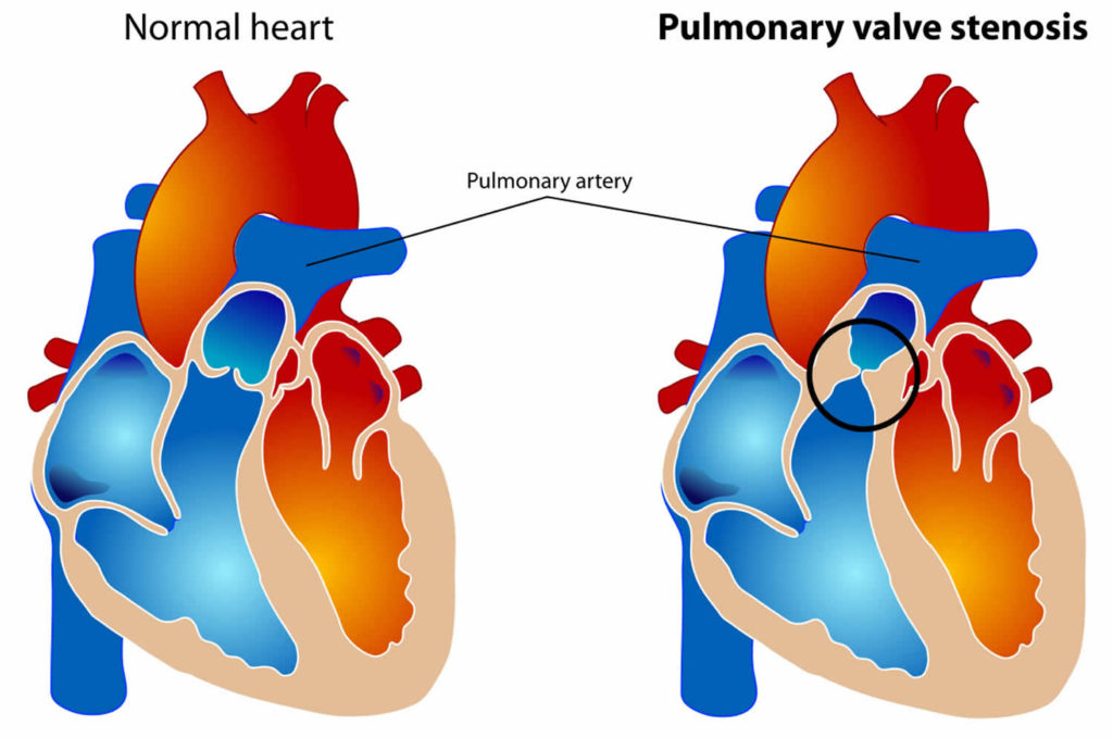 Pulmonary Valve Stenosis Causes Symptoms Diagnosis And Treatment 4998