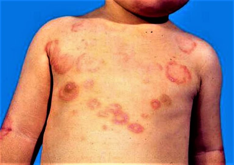 Rheumatic Heart Disease Symptoms Skin