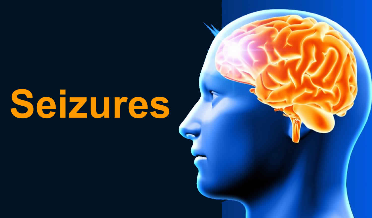 Seizures Types Causes Symptoms Diagnosis Treatment