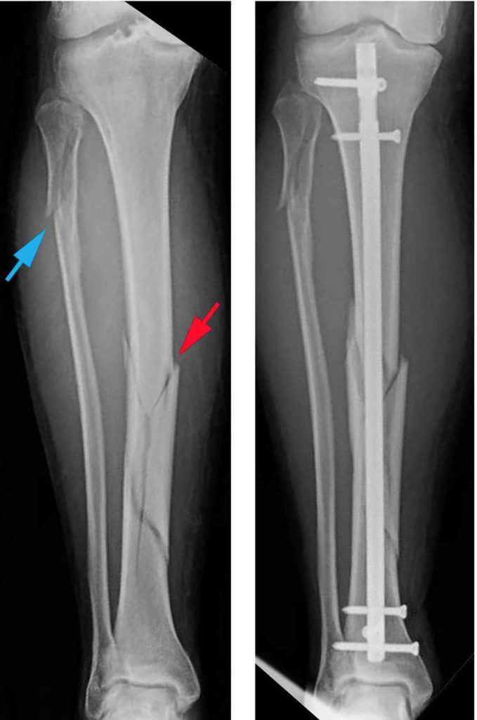 Spiral Fracture Definition English