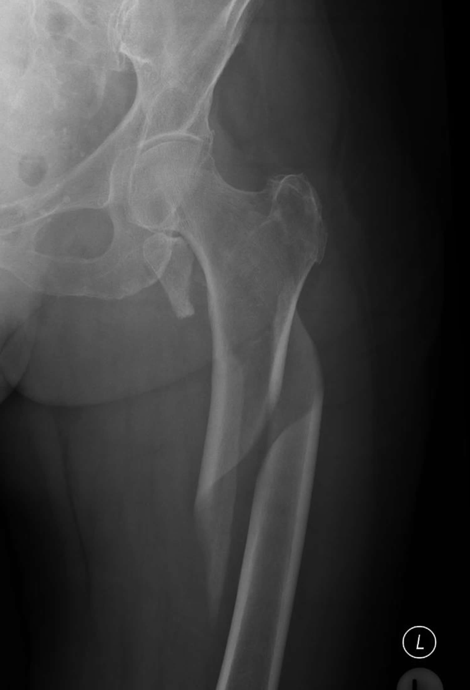 Types Of Spiral Fractures