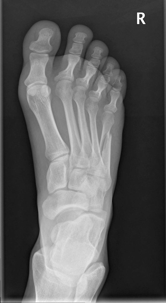 spiral-fracture-distal-fibula